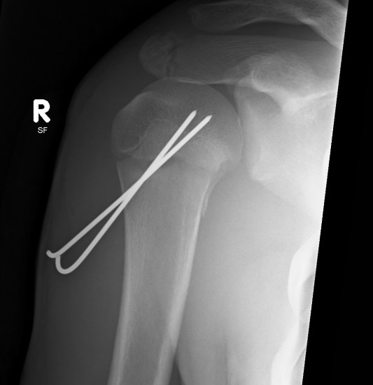 Paediatric Shoulder K wires